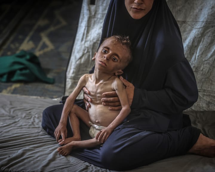 "Charity reports childhood malnutrition in Gaza triples in two weeks"